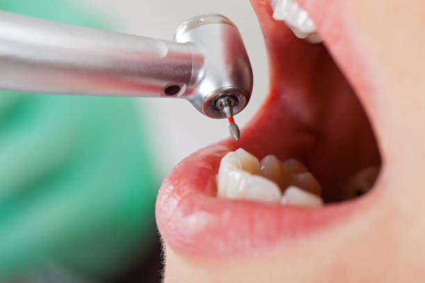 Best Knocked-Out Tooth (Avulsed Tooth) Treatment in Moosup, CT